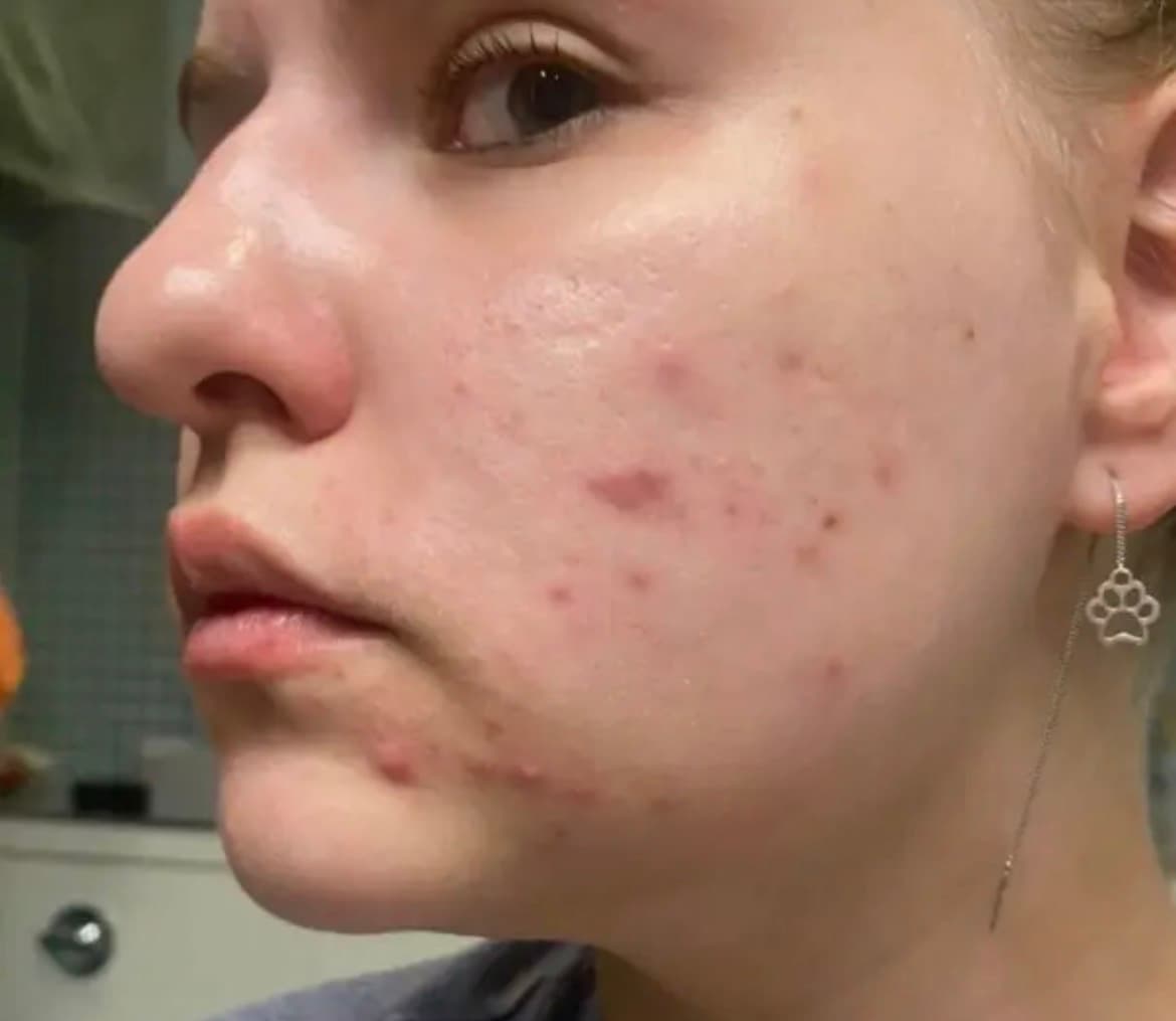 Acne and blemishes before using shower filter